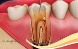 کشتن عصب دندان در خانه (روش های عصب کشی دندان در خانه)